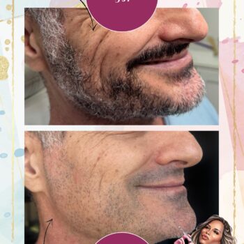 חג שמח ומועדים לשמחה אהובות 🤩
מה אומרות רואים את ההבדל? 🥰💫העור נראה חיוני יותר, מוצק, עם זוהר טבעי ורעננות שקשה לפספס – וזה בלי חומרי מילוי, ובלי שינוי בתווי הפנים.
רק חידוש פנימי ואמיתי של העור, מבפנים.מה עשה את השינוי?
טיפול ביוסטימולטור – כמו סקולפטרה, אסתפיל או אולידיה – שמעודד את הגוף לייצר מחדש קולגן, האלמנט שהולך ופוחת עם השנים.
וכשיש יותר קולגן – העור נראה צעיר יותר, מתוח יותר, ומתחזק עם הזמן.למי זה מתאים?
לנשים (וגם גברים!) בגילאי 35+
שרוצות לשמר את המראה הצעיר, לטפל בדקיקות העור, לשפר מרקם ולטפל בצניחה עדינה – עוד לפני שצריך טיפולים דרמטיים יותר.והכי חשוב:
זו לא הבטחה לרגע. זו השקעה לשנים קדימה.רוצה לדעת אם זה מתאים גם לעור שלך?
שלחי לי הודעה או קבעי ייעוץ – ונבנה יחד תוכנית מותאמת אישית ❤️
לינק בביו 🥰#ביוסטימולטור #ביוטי #יופי #הזרקות_חומצה_הילארונית #הזרקות #אסתטיקה #יופיוטיפוח #רופאה #קולגן #חומצההיאלרונית #חומצהפולילקטית #סקולפטרה #אסתפיל #אולידיה #טיפוח #אסתטיקהלגברים