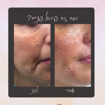 היי אהובות ❤️אם שמעתן את המונח ״פיסול פנים״ ולא הבנתן על מה מדובר, אז אני כאן כדי להסביר 🥰פיסול פנים מבוצע עם חומצה היאלורונית והוא פתרון מושלם למי שרוצה להחזיר לפנים נפח שאבד עם הזמן, לעצב מחדש את קו הלסת, הלחיים והסנטר, וכל זה מבלי לשנות את המראה הטבעי.החומצה ההיאלורונית משתלבת באופן טבעי בפנים, כך שהמראה נשאר רך ורענן לאורך זמן ✨רוצה לדעת אם זה מתאים גם לך?
אני כאן לייעוץ והתאמה אישית! מוזמנת לקבוע איתי פגישה אישית לייעוץ בפיד ❤️ ללא עלות או התחייבותאוהבת 🫶🏻