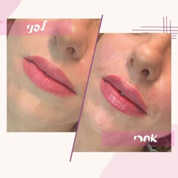היי אהובות שלי 💖תראו איך אפשר לעשות שפתיים בצורה מאוד עדינה וטבעית, ועדיין לקבל שינוי מרענן ומטופח 🤩מטופלת שלי מדהימה הגיעה אליי אחרי ניסיון פחות מוצלח עם פיגמנט שפתיים 👄החלטנו יחד לבצע הזרקה שתסדר את הצורה ותשיב לה את הביטחון בשפתיים שלה.
התוצאה שיצרנו הייתה עדינה, טבעית ומדויקת – בדיוק כמו שהיא ביקשה 🫶🏻חשוב לי להראות שלא צריך לפחד מטיפולים אסתטיים.
כשהם מבוצעים בצורה נכונה, הם רק משפרים את המראה הטבעי ויוצרים את הגרסה הטובה ביותר של עצמך 🥰אוהבת אתכן ❤️